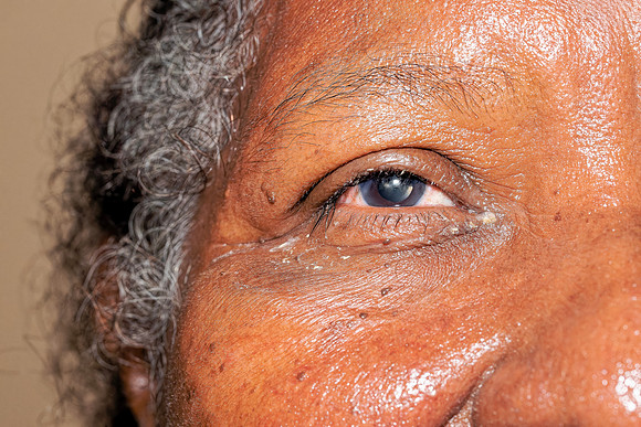 NoSP-Cataract-Amaya1