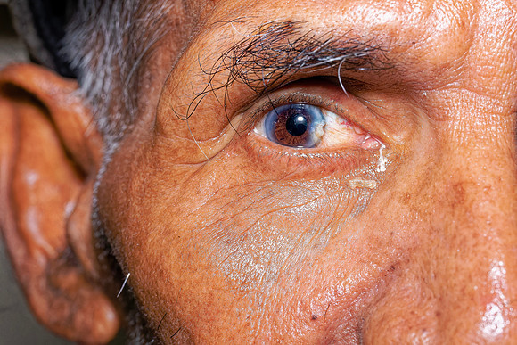 NoSP-Cataract-Villanueva1
